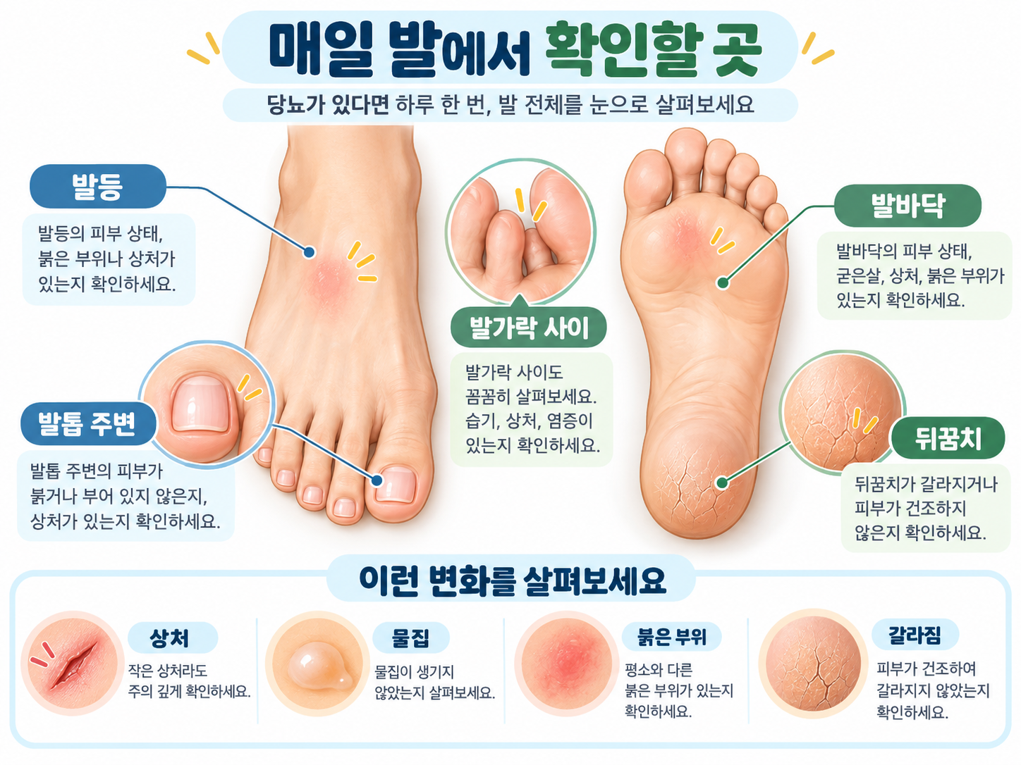 당뇨가 있을 때 매일 확인해야 할 발등, 발바닥, 발가락 사이, 발톱 주변과 뒤꿈치를 설명한 그림